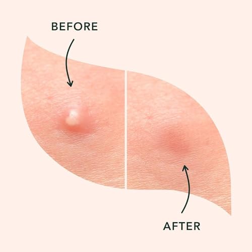 a.l.m. Magical Hydrocolloid Pimple Patches - Invisible Acne Spot Treatment