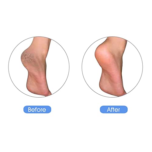 KuuCare Natural Lava Pumice Stone Callus Remover for Feet and Heels