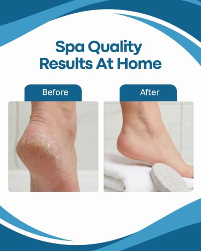 Denco Pumice Stone Callus Remover & Natural Foot Scrubber for Dead Skin