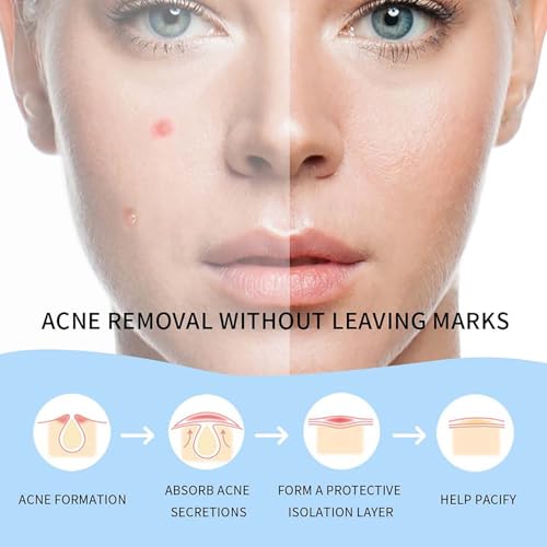 Safirst Hydrocolloid Acne Patches 36 Count Invisible Blemish Spot Stickers