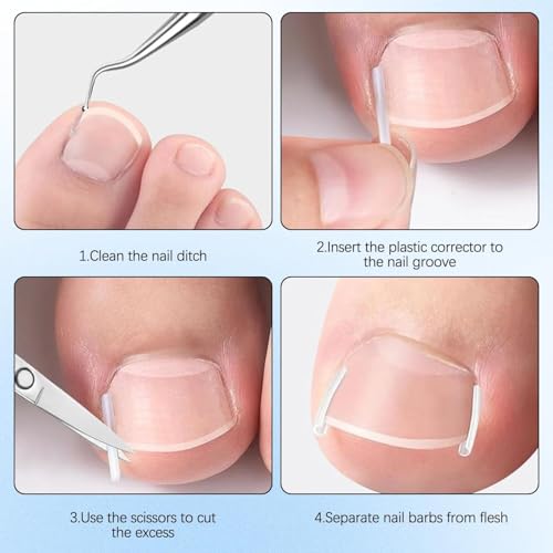 Ingrown Toenail Removal Kit with Correction Patches and Stainless Steel Tools