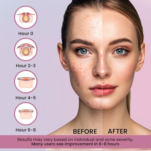 Andlane Cute Pimple Patches - 260 Pcs Hydrocolloid Acne Zit Stickers