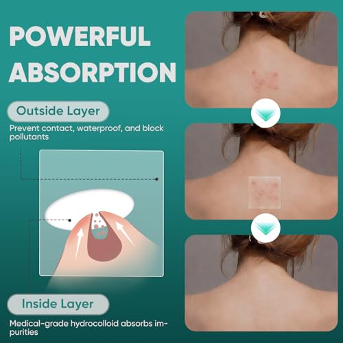 Kindshine Large Hydrocolloid Acne Patches - 20 Pcs Extra Large Pimple Patches for Face & Body