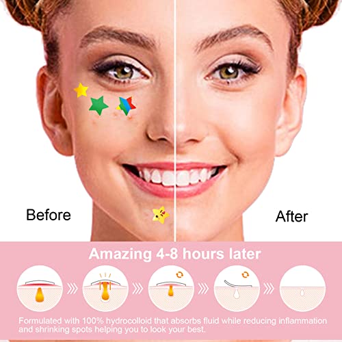 Star Pimple Patches 96 Pcs - Hydrocolloid Acne Spot Treatment Cover