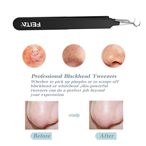 FEITA Curved Blackhead Extraction Tweezers - Surgical Stainless Steel Comedone Extractor Tool for Pimple and Acne Removal