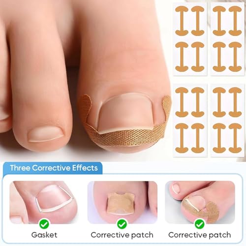 Ingrown Toenail Removal Kit with Correction Patches and Stainless Steel Tools