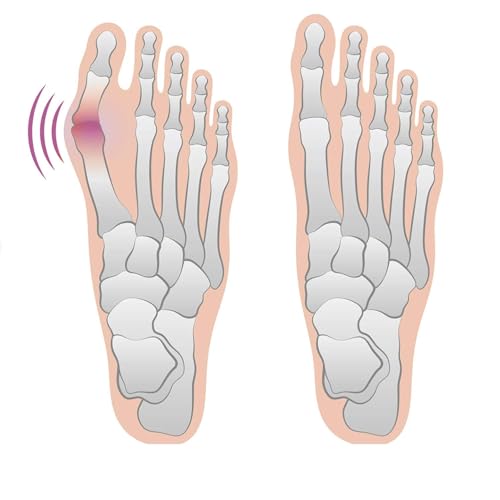 4 Bunion Relief Pads and Sleeves, Orthopedic Bunion Corrector Socks with Gel Pads, 2 Pairs