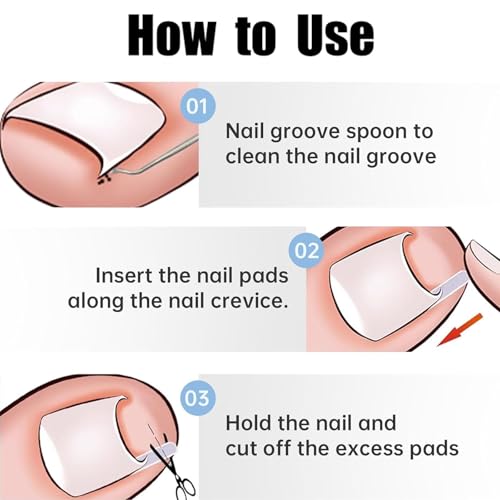 50 Pcs Ingrown Toenail Corrector Strips Kit - Pain Relief Pedicure Tool