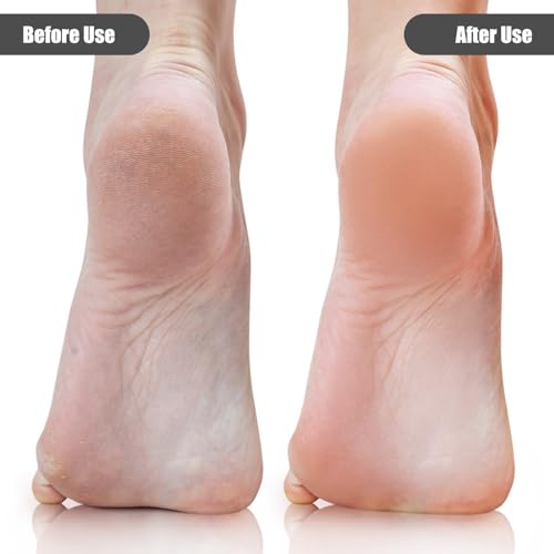 Sorcristy 2-Pack Transparent Foot File Callus Remover for Hard Skin