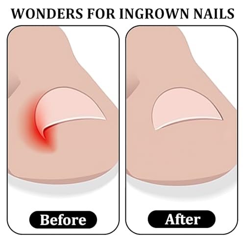 Ingrown Toenail Clippers & Straight Blade Nail Tool for Thick Nails