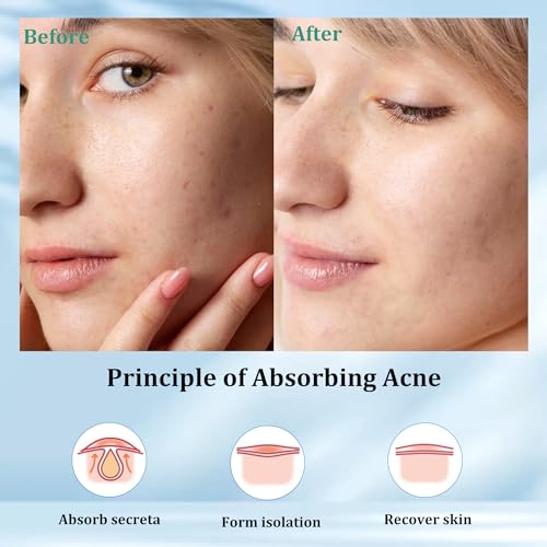 SHIVRISE Hydrocolloid Pimple Patches - Invisible Acne Spot Cover (36 Count)