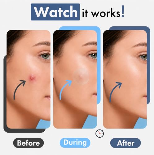 Hellados 450 Pimple Patches - Hydrocolloid Acne Spot Stickers with Tea Tree & Calendula Oil