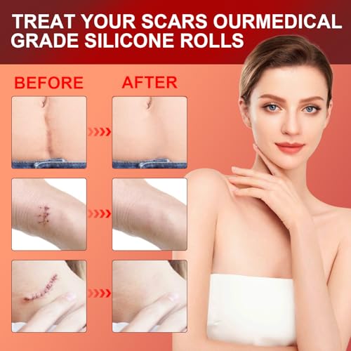 Tearich Silicone Scar Sheets - Medical Grade Scar Tape Roll for C-Section, Surgery & Burns