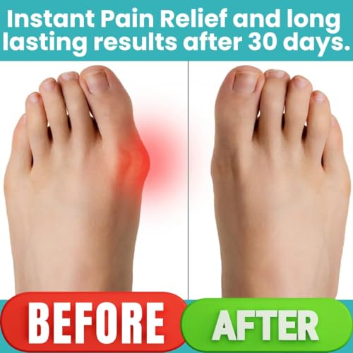2PC Bunion Corrector for Women & Men ? Toe Straightener Socks for Hallux Valgus, Pain Relief, Non-Slip, Breathable, Day & Night Use, Washable, L/R Foot Set