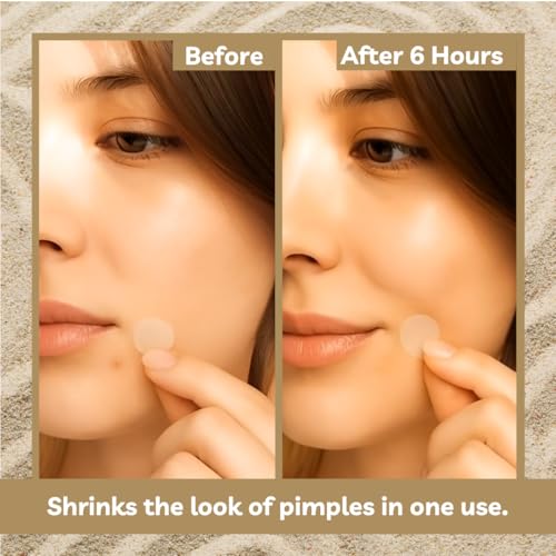 Icon Hydrocolloid Acne Pimple Patches 72 Count - Nighttime Blemish Spot Stickers