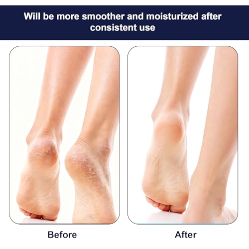 Moisturizing Heel Socks 3 Pairs - Toeless Gel Socks for Dry Cracked Feet & Spa Care