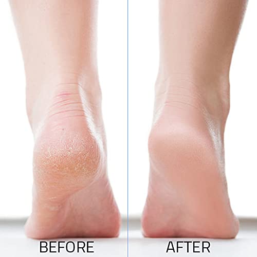 JAIRESTONE Pumice Stone Callus Remover & Foot Scrubber, Pack of 2 White