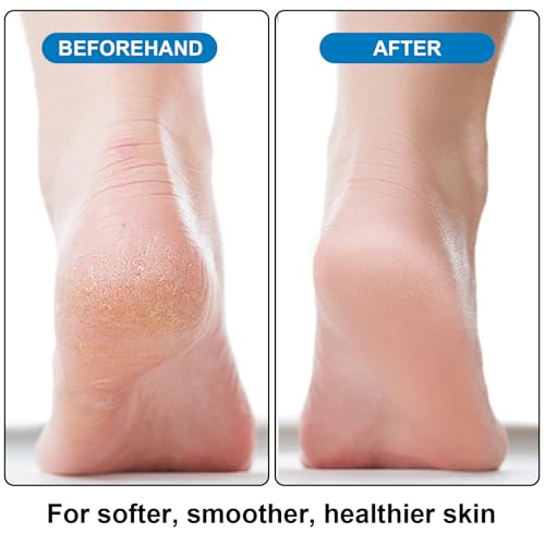 Foot Pumice Stone 2-Pack Callus Remover & Scrubber for Feet, Purple