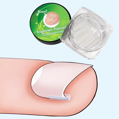 Ingrown Toenail Correction Strips Brace Kit - 10 Pcs Pedicure Tool