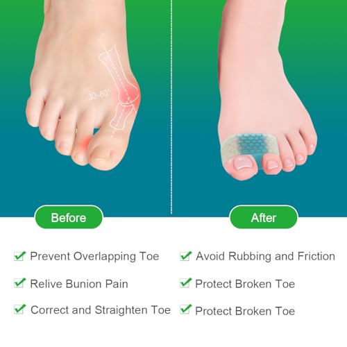 SEBS Toe Spacers & Bunion Correctors for Hallux Valgus Relief 4-Pack