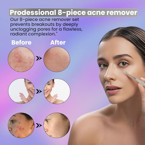 8-Piece Blackhead Remover & Acne Extractor Tool Kit in Stainless Steel