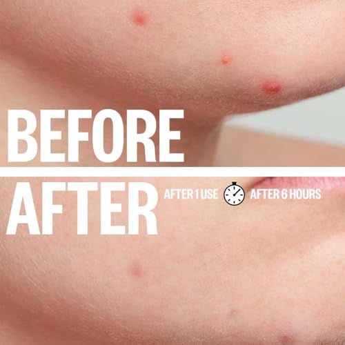 a.l.m. Magical Hydrocolloid Pimple Patches - Invisible Acne Spot Treatment
