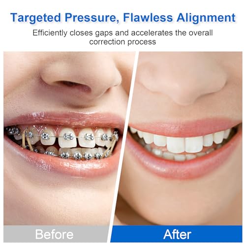Keilend Orthodontic Rubber Bands 500 Pcs 3/8 Inch Heavy 4.5 Oz with 5 Placers