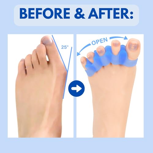 Shimsol Soft Silicone Toe Spacers for Bunion Relief and Pedicure