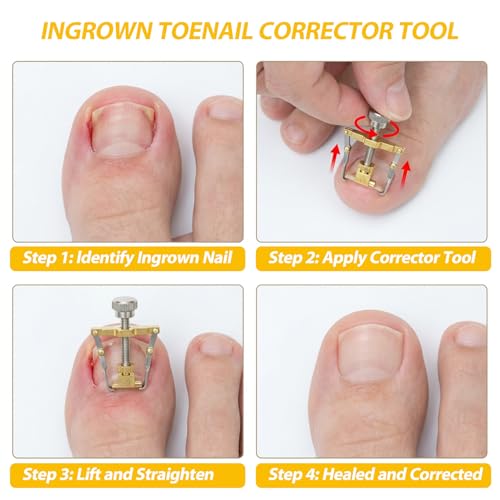 8-Piece Ingrown Toenail Removal Kit & Corrector Tool with Storage Box