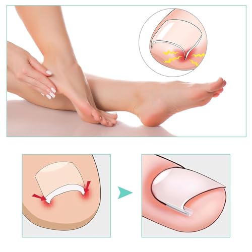 50 Pcs Ingrown Toenail Corrector Strips Kit - Pain Relief Pedicure Tool