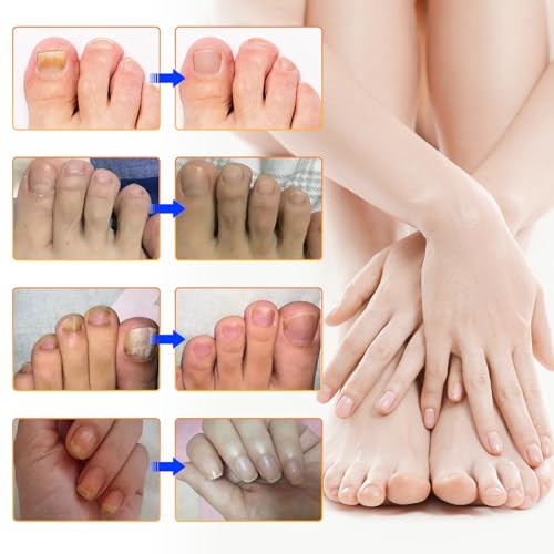 Ruduwu Extra Strength Toenail Treatment Patches - 32 Overnight Nail Repair Strips