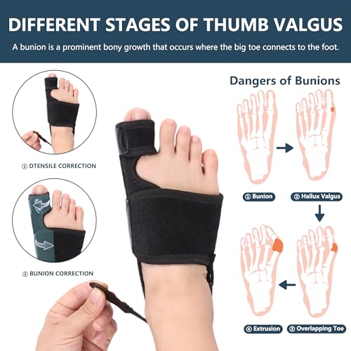 2 Pack Bunion Corrector for Women & Men, Orthopedic Bunion Splint for Hallux Valgus Pain Relief, Big Toe Separator, Adjustable Day/Night Support, Comfortable Hammer Toe Straightener