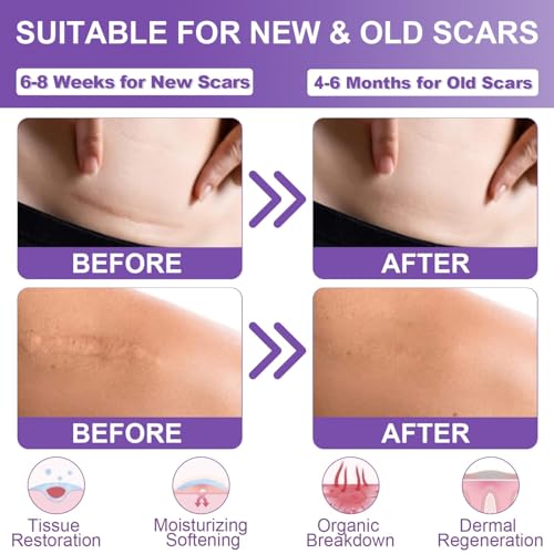 Mitgary Silicone Scar Sheets - Medical Grade Tape for C-Sections & Surgeries