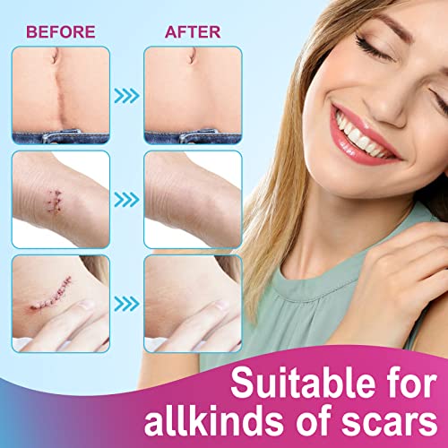 Silicone Scar Tape Roll, 1.6" x 75" Medical Grade Scar Sheets for Old and New Scars