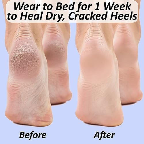 The Foot Medic Moisturizing Gel Heel Socks for Cracked Foot Treatment