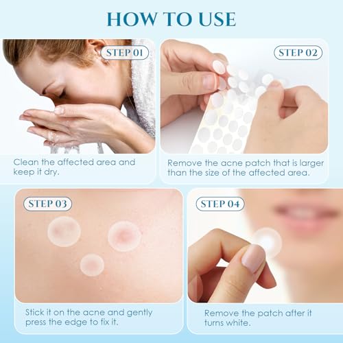 PITHER Hydrocolloid Pimple Patches - 288 Count Acne Zit Stickers