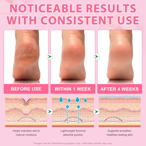 Urea Cream Foot Callus Remover Stick - 60% Urea & 2% Salicylic Acid