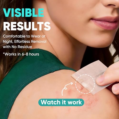Kindshine Large Hydrocolloid Acne Patches - 20 Pcs Extra Large Pimple Patches for Face & Body